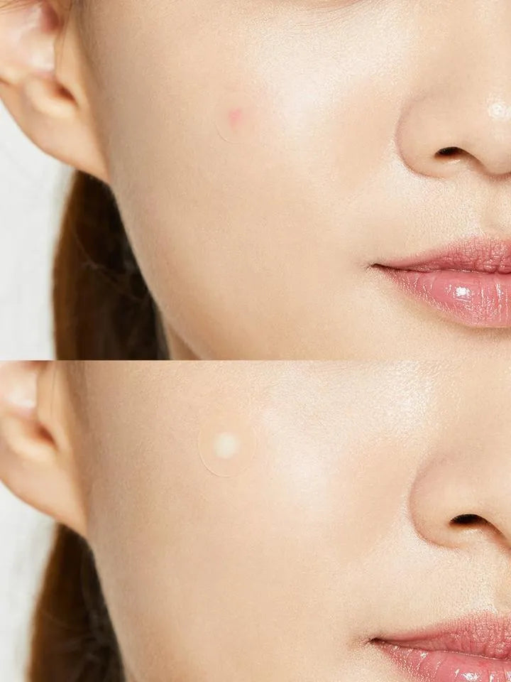 Close-up of a woman's cheek before and after using COSRX Acne Pimple Master Patch, Korean skincare.